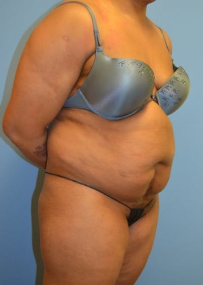 Liposuction and Smartlipo Gallery - Patient 5883324 - Image 1