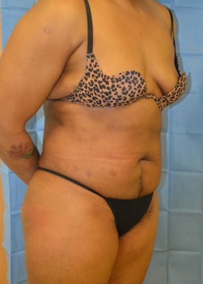 Liposuction and Smartlipo Before & After Gallery - Patient 5883324 - Image 2