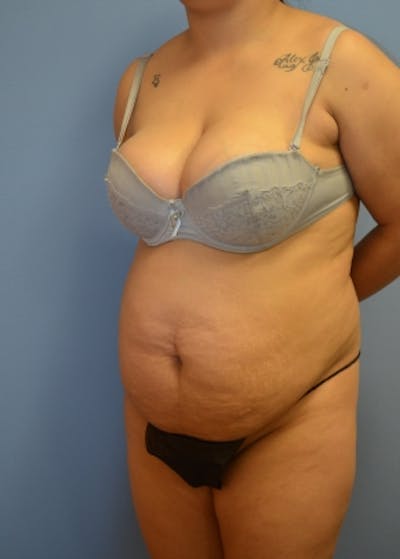 Tummy Tuck Before & After Gallery - Patient 5883325 - Image 1
