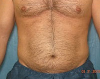 Liposuction and Smartlipo Before & After Gallery - Patient 5883326 - Image 1