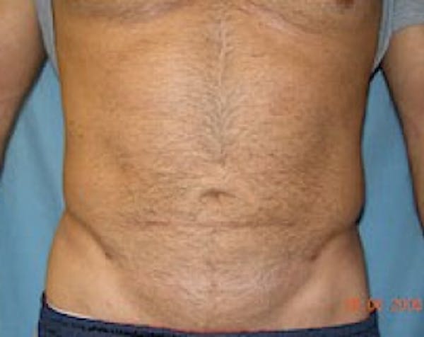 Liposuction and Smartlipo Before & After Gallery - Patient 5883326 - Image 2