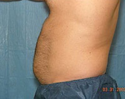 Liposuction and Smartlipo Before & After Gallery - Patient 5883328 - Image 1