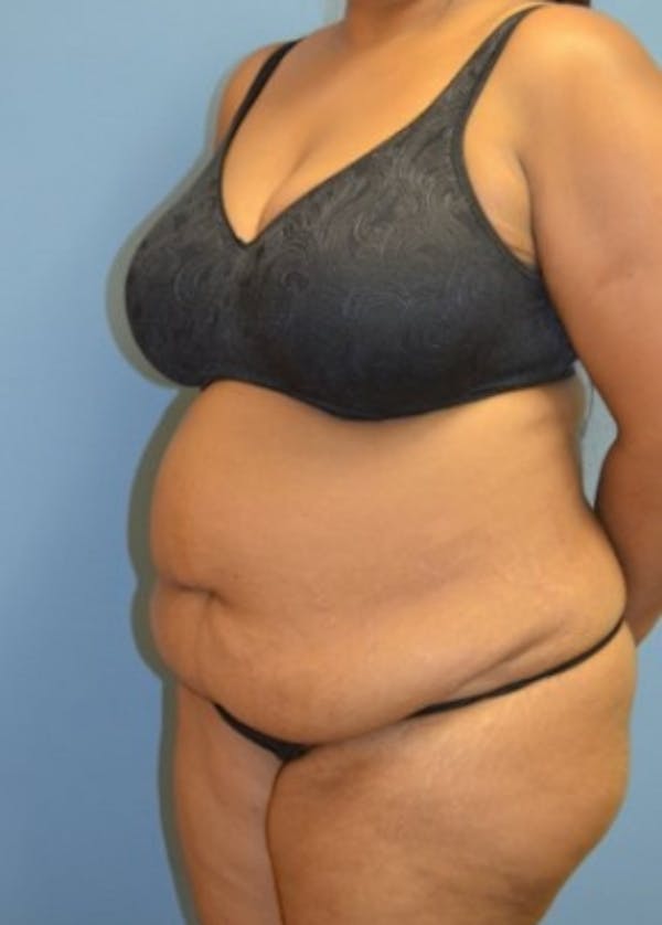 Tummy Tuck Before & After Gallery - Patient 5883329 - Image 1