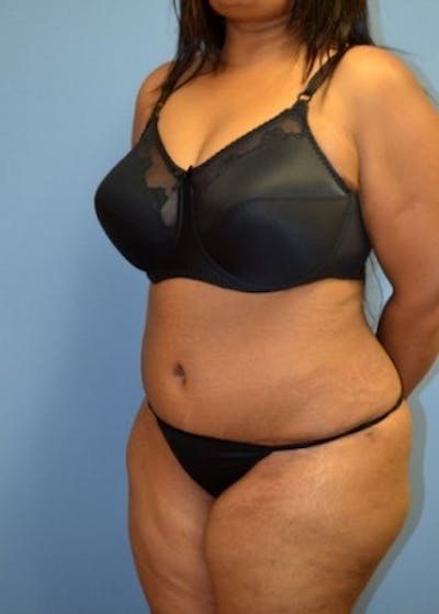 Tummy Tuck Before & After Gallery - Patient 5883329 - Image 2