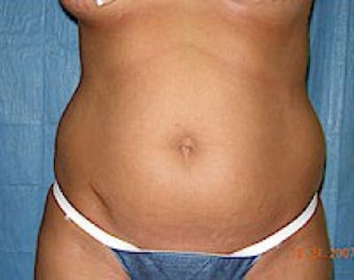 Liposuction and Smartlipo Gallery - Patient 5883330 - Image 1