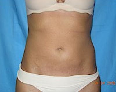 Liposuction and Smartlipo Before & After Gallery - Patient 5883330 - Image 2