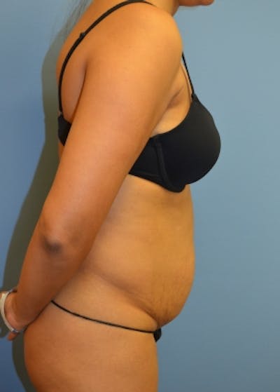 Tummy Tuck Before & After Gallery - Patient 5883331 - Image 1