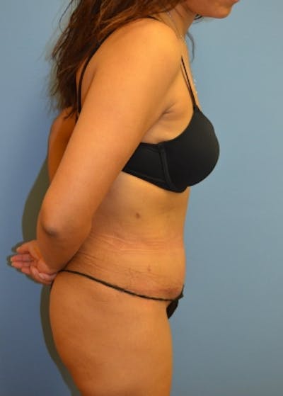 Tummy Tuck Before & After Gallery - Patient 5883331 - Image 2