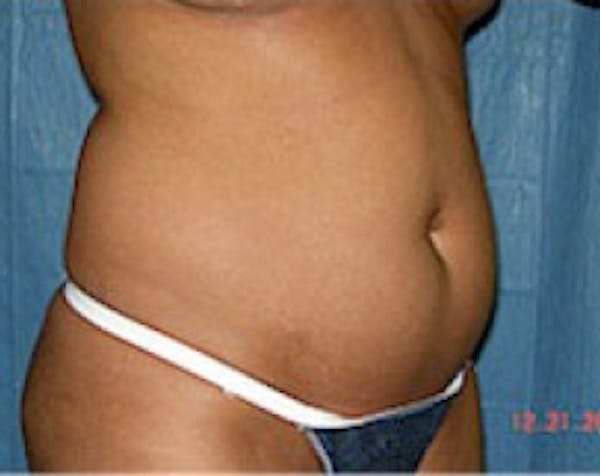 Liposuction and Smartlipo Before & After Gallery - Patient 5883332 - Image 1