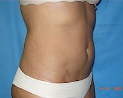 Liposuction and Smartlipo Before & After Gallery - Patient 5883332 - Image 2