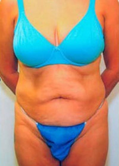 Tummy Tuck Before & After Gallery - Patient 5883333 - Image 1