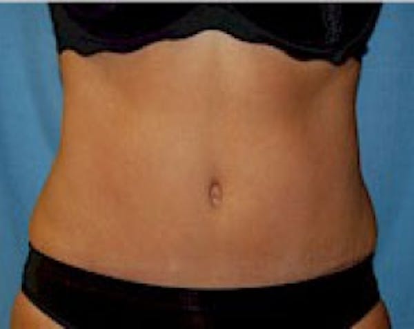 Liposuction and Smartlipo Gallery - Patient 5883334 - Image 1