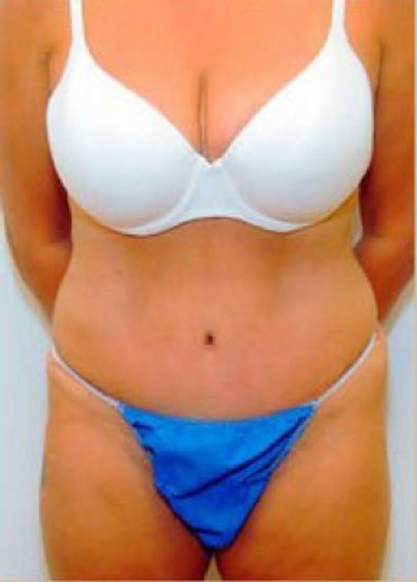 Tummy Tuck Before & After Gallery - Patient 5883333 - Image 2