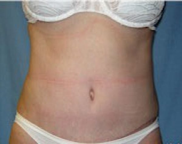 Liposuction and Smartlipo Before & After Gallery - Patient 5883334 - Image 2