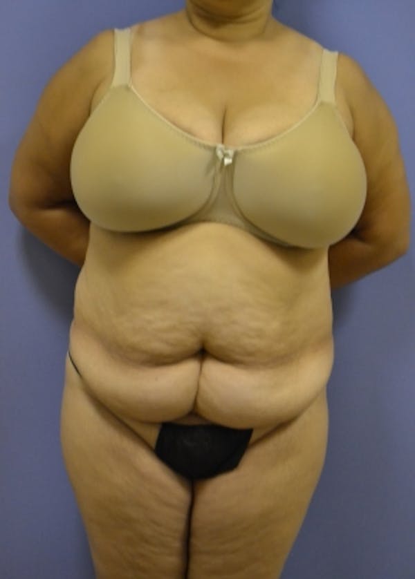 Tummy Tuck Before & After Gallery - Patient 5883335 - Image 1