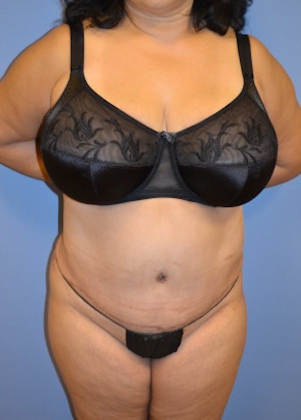 Tummy Tuck Before & After Gallery - Patient 5883335 - Image 2