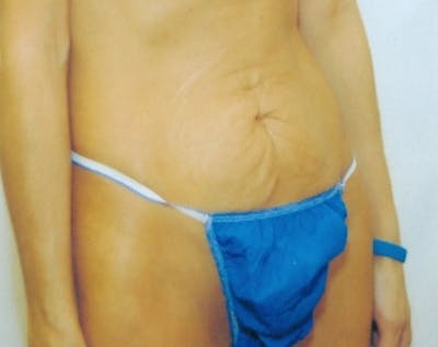 Tummy Tuck Before & After Gallery - Patient 5883337 - Image 1