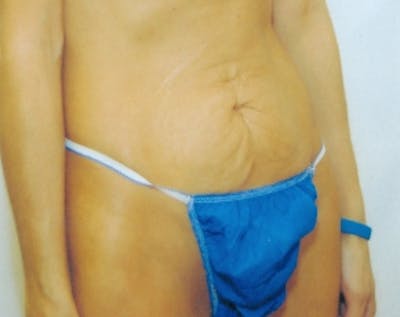 Tummy Tuck Gallery - Patient 5883337 - Image 1