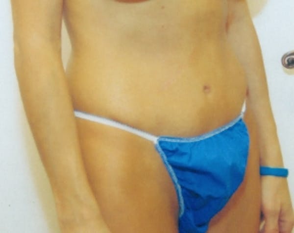 Tummy Tuck Gallery - Patient 5883337 - Image 2