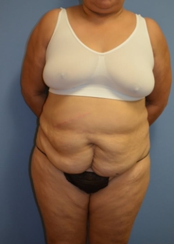 Tummy Tuck Before & After Gallery - Patient 5883340 - Image 1