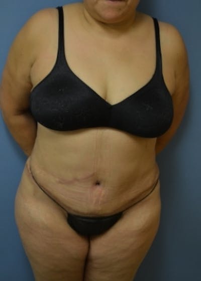 Tummy Tuck Before & After Gallery - Patient 5883340 - Image 2