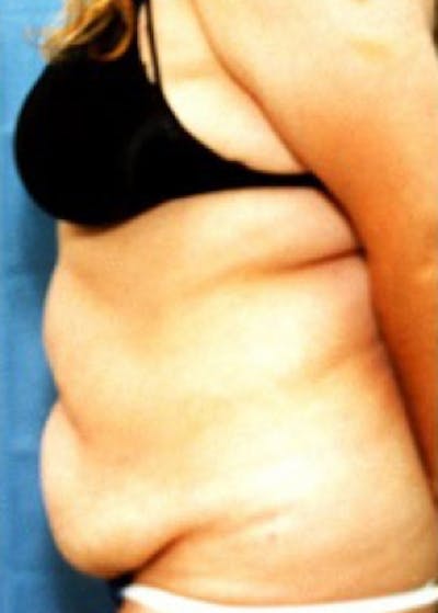 Liposuction and Smartlipo Before & After Gallery - Patient 5883341 - Image 1