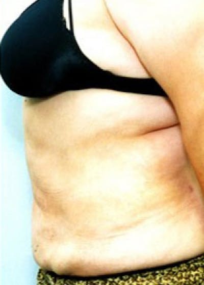 Liposuction and Smartlipo Before & After Gallery - Patient 5883341 - Image 2