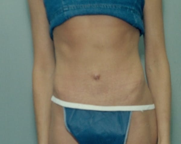 Tummy Tuck Before & After Gallery - Patient 5883342 - Image 2