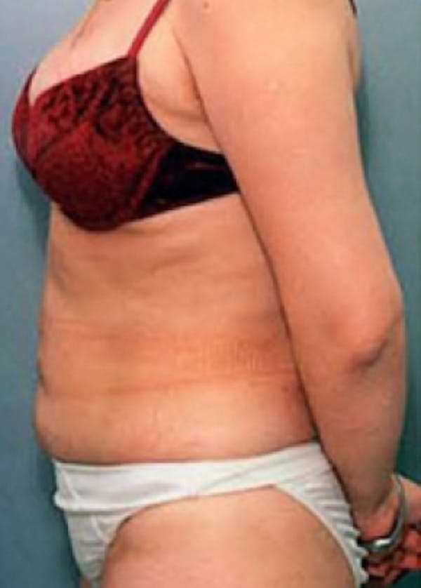 Liposuction and Smartlipo Before & After Gallery - Patient 5883343 - Image 2