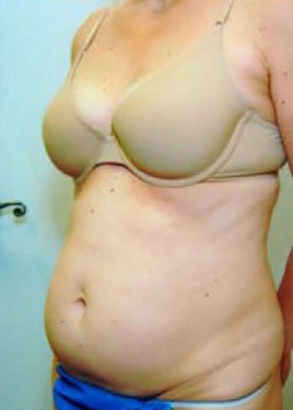 Tummy Tuck Before & After Gallery - Patient 5883344 - Image 1