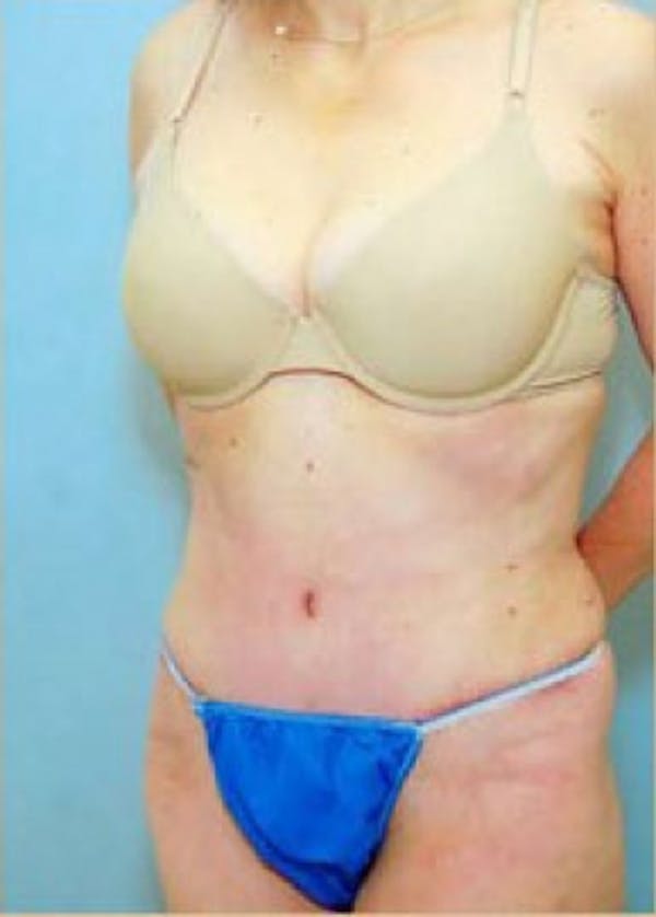 Tummy Tuck Before & After Gallery - Patient 5883344 - Image 2