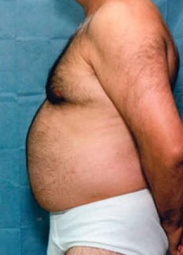 Liposuction and Smartlipo Gallery - Patient 5883345 - Image 1
