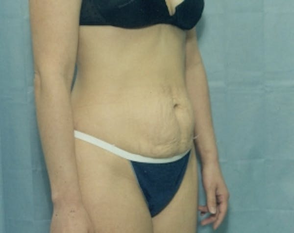 Tummy Tuck Before & After Gallery - Patient 5883346 - Image 1