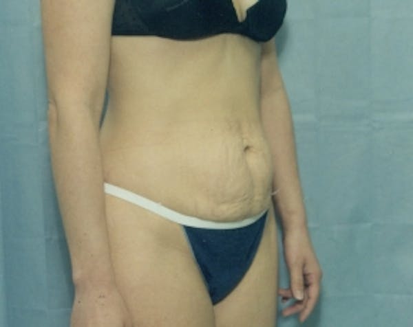 Tummy Tuck Before & After Gallery - Patient 5883346 - Image 1