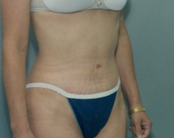 Tummy Tuck Before & After Gallery - Patient 5883346 - Image 2