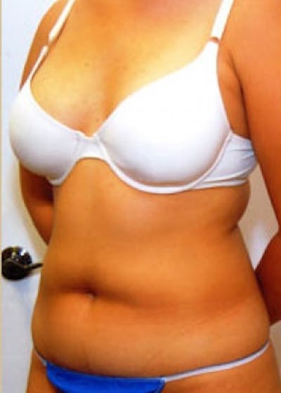 Liposuction and Smartlipo Before & After Gallery - Patient 5883347 - Image 1