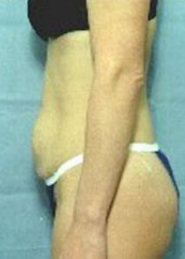 Tummy Tuck Before & After Gallery - Patient 5883348 - Image 1