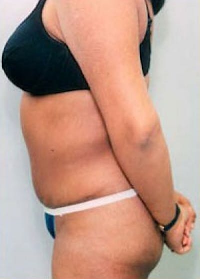 Tummy Tuck Before & After Gallery - Patient 5883350 - Image 2