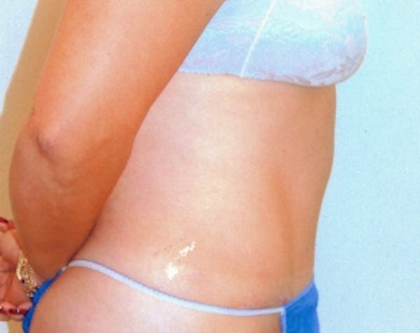 Tummy Tuck Before & After Gallery - Patient 5883352 - Image 2