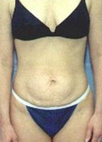 Tummy Tuck Before & After Gallery - Patient 5883354 - Image 1