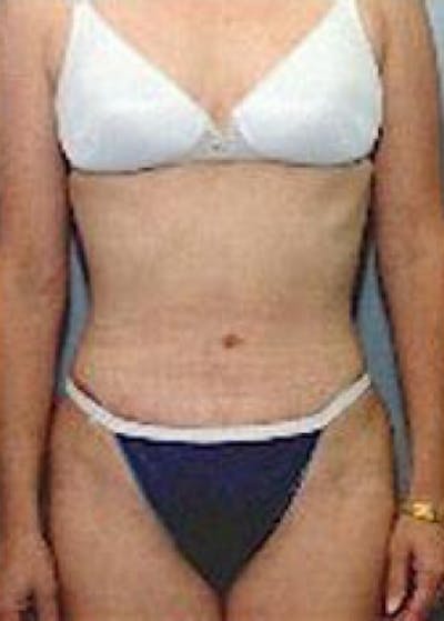 Tummy Tuck Before & After Gallery - Patient 5883354 - Image 2