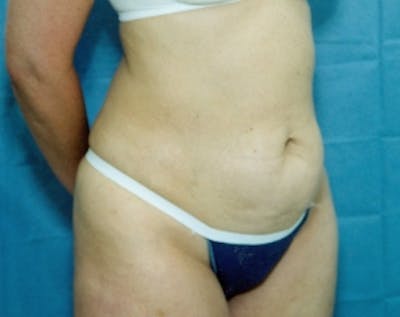 Liposuction and Smartlipo Gallery - Patient 5883355 - Image 1