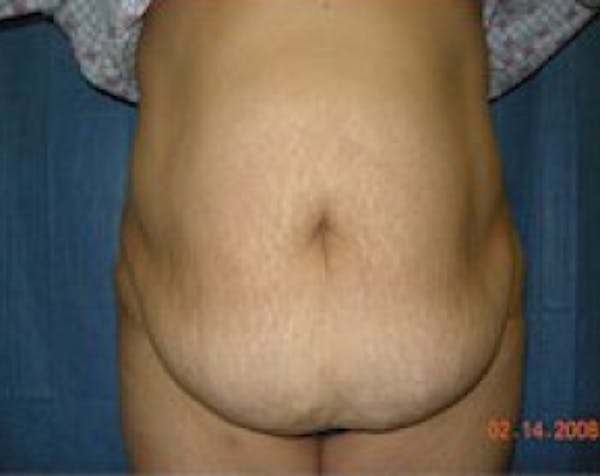 Tummy Tuck Before & After Gallery - Patient 5883357 - Image 1