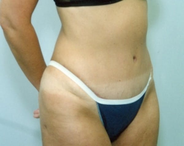 Liposuction and Smartlipo Gallery - Patient 5883355 - Image 2