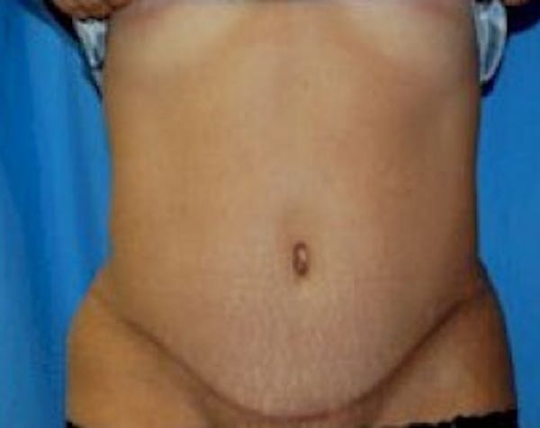 Tummy Tuck Before & After Gallery - Patient 5883357 - Image 2