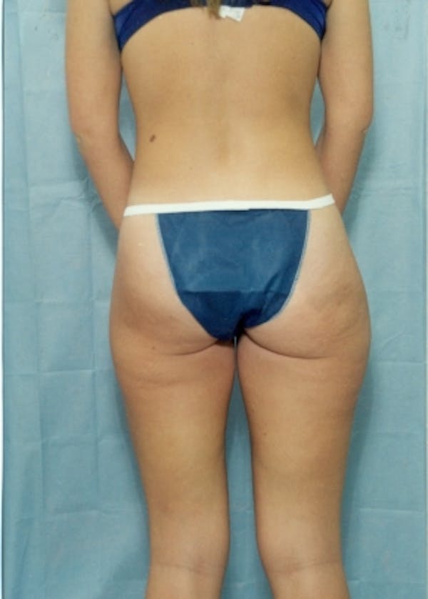 Liposuction and Smartlipo Before & After Gallery - Patient 5883356 - Image 1
