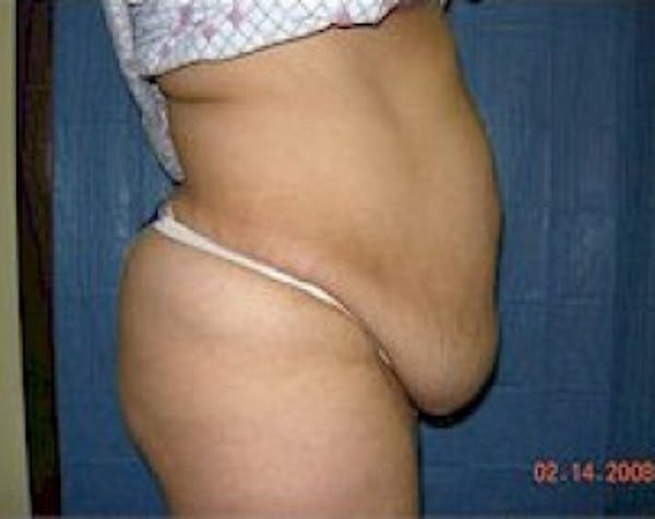 Tummy Tuck Before & After Gallery - Patient 5883357 - Image 3