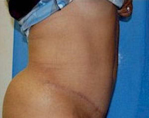 Tummy Tuck Before & After Gallery - Patient 5883357 - Image 4