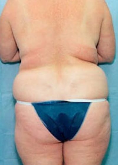 Liposuction and Smartlipo Before & After Gallery - Patient 5883358 - Image 1