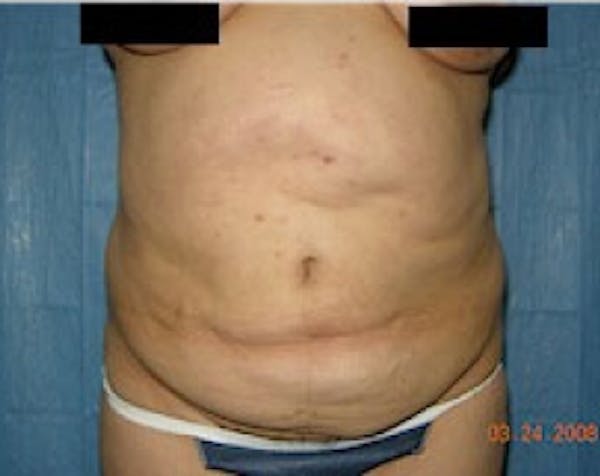 Tummy Tuck Before & After Gallery - Patient 5883359 - Image 1